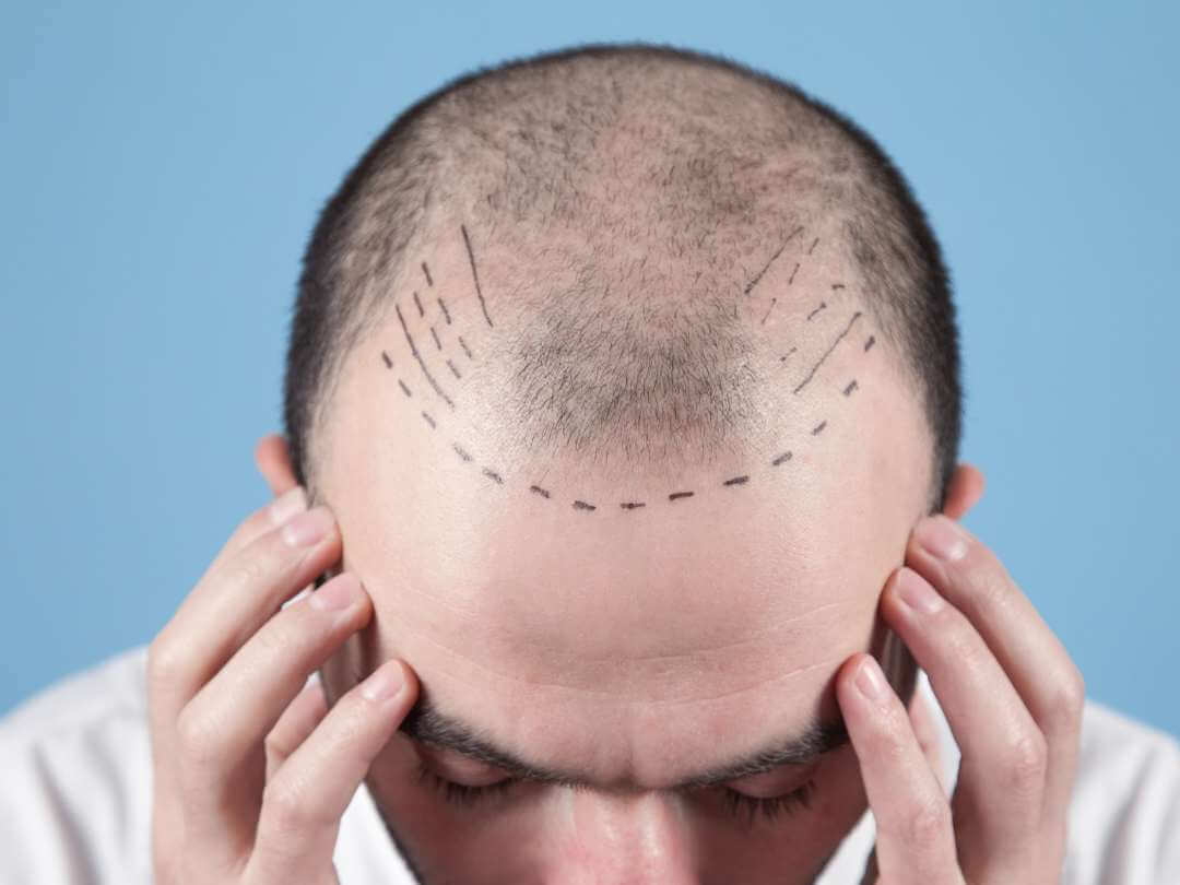 trapianto di capelli ferrara